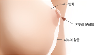 유방자가검진 첫 단계